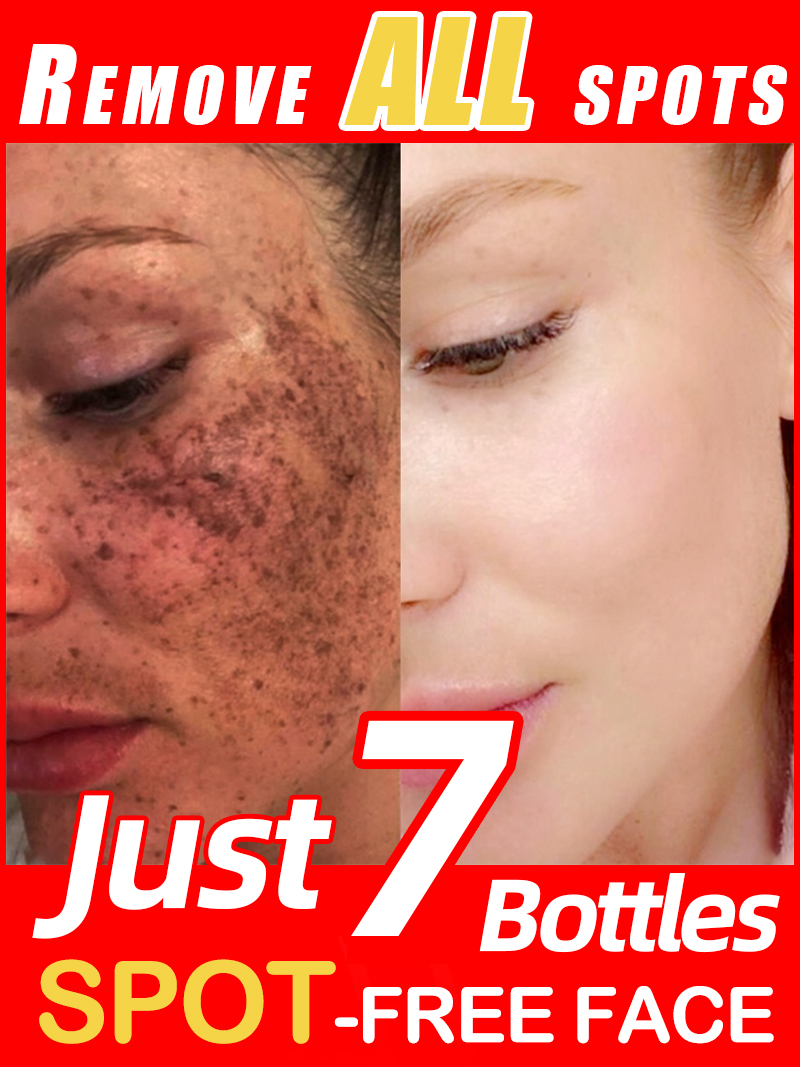 Luxury Skincare Essence - Ilumine sardas melasma, manchas escuras faciais